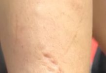 Una luchadora mostró cómo le quedó el brazo tras sufrir múltiples mordeduras de su rival durante el combate: “Dejaré que las marcas hablen”